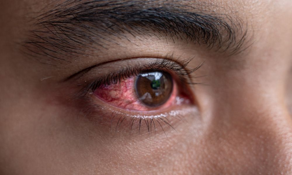 Red eye treatment