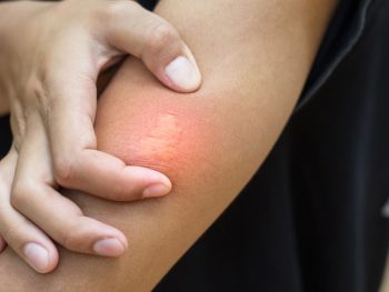 bee-bite-treatment Treatment for Bee Bite