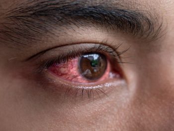 red-eye-infection-treatment Red eye treatment