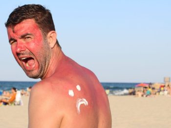 sun-burn How To Treat Sunburn Naturally